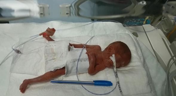 285 gram doğan Elçin yaşama sıkı sıkı tutundu! 1