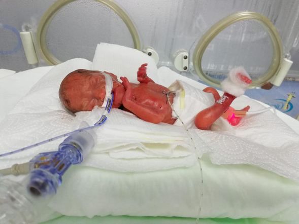 285 gram doğan Elçin yaşama sıkı sıkı tutundu! 2