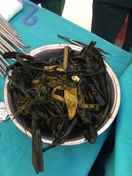 Karnından çıkanlar doktorları bile şoke etti! 5