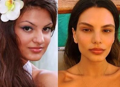 Almeda Abazi'den 'estetik' isyanı! 4