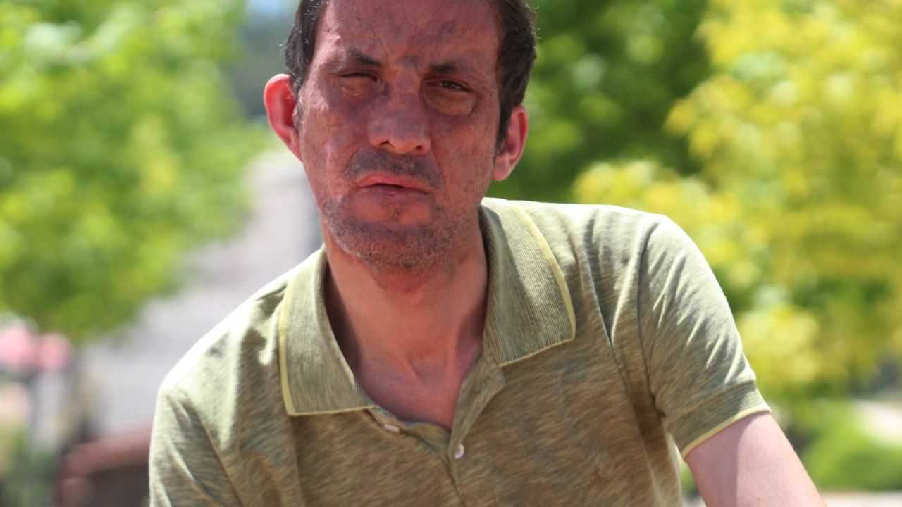 İşte yüz nakli yaptıran Uğur Acar'ın son hali! 8