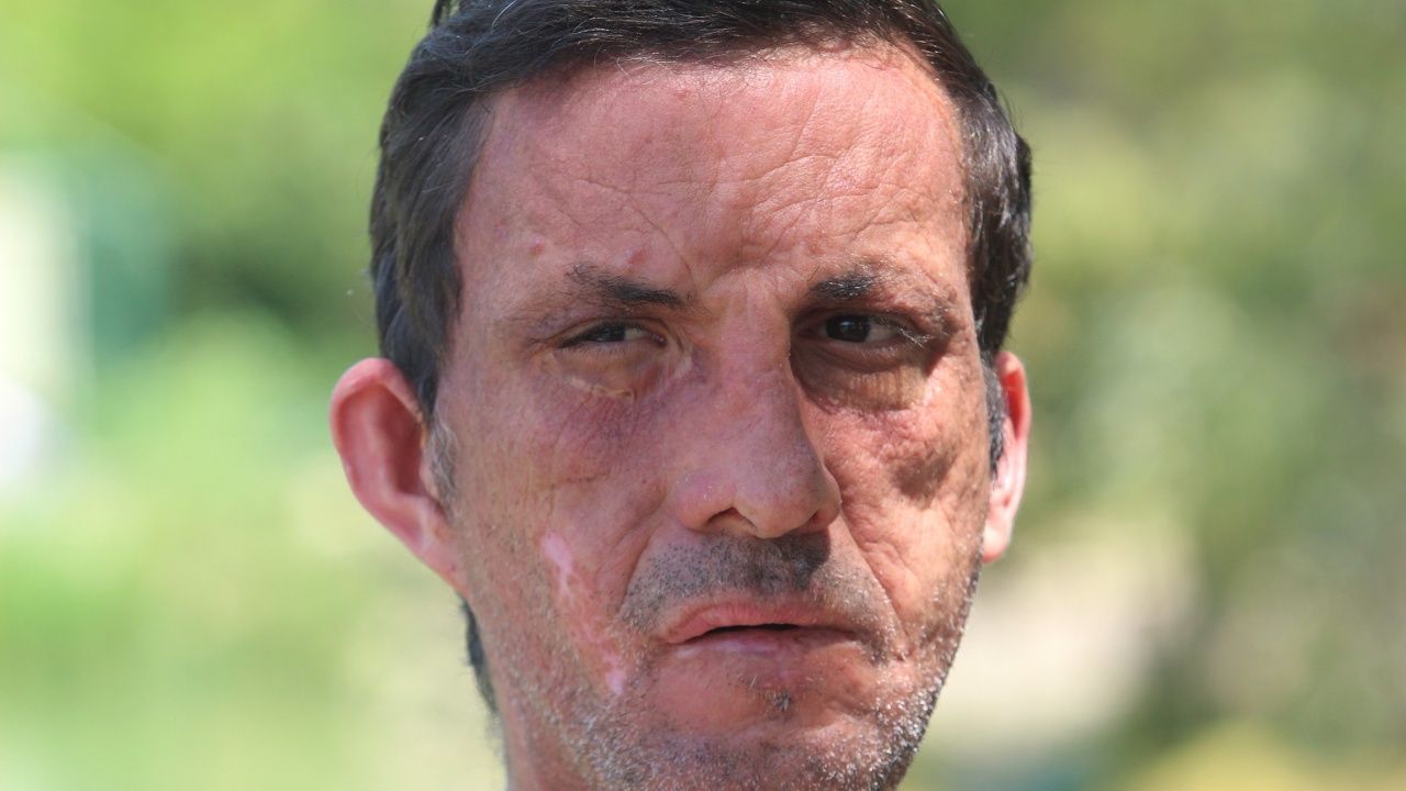 İşte yüz nakli yaptıran Uğur Acar'ın son hali! 6