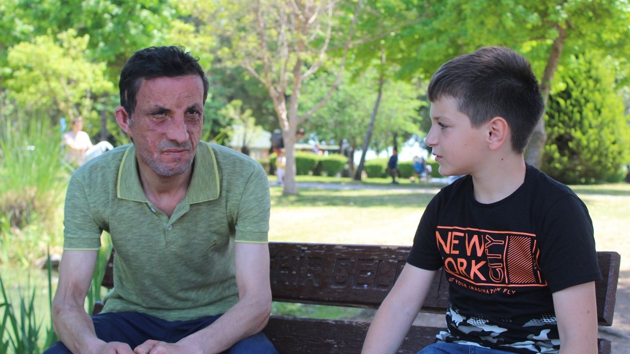 İşte yüz nakli yaptıran Uğur Acar'ın son hali! 11