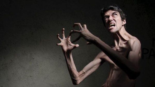 Genetik hastalığından dolayı filmlerin aranan yüzü oldu! 4