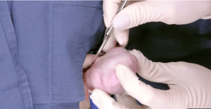 Piercing taktırdığı için kulağı bu hale geldi! 5