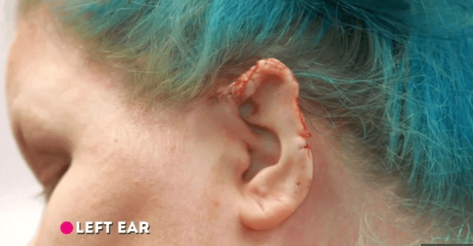 Piercing taktırdığı için kulağı bu hale geldi! 2