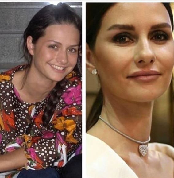 Estetik operasyonlarıyla bambaşka birine dönüştüler! 9