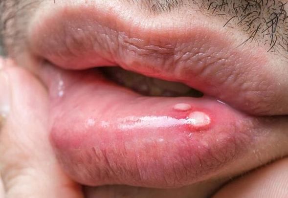 Dudağınızda bu yara varsa 'HIV' olabilirsiniz! 3