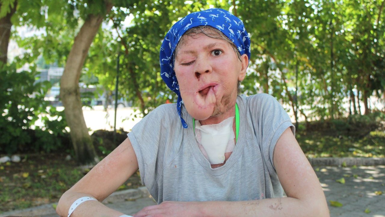 Önemsemediği sivilce onu bu hale getirdi! 1