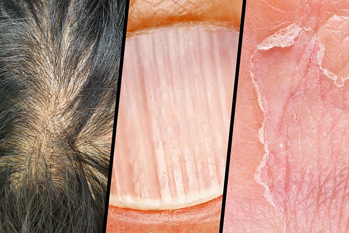 Protein eksikliği çekildiğini gösteren durumlar! 3