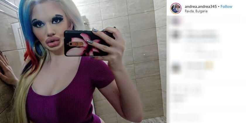 Dudağını bu hale getirmek için servet harcadı! 3