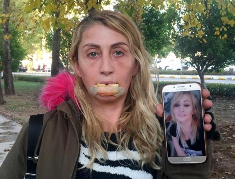 Güzellik uğruna alt dudağını kaybetti! Kötü haber geldi... 1