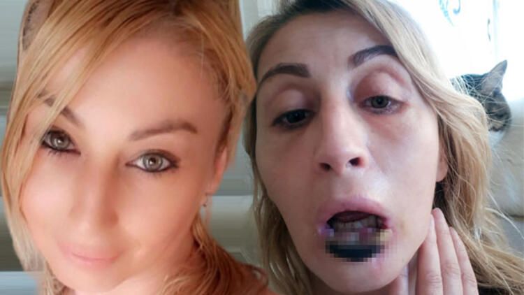 Güzellik uğruna alt dudağını kaybetti! Kötü haber geldi... 8