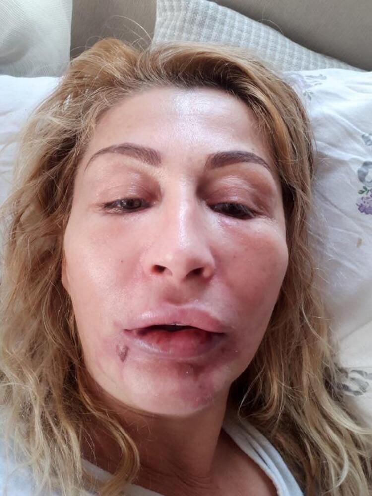 Güzellik uğruna alt dudağını kaybetti! Kötü haber geldi... 12