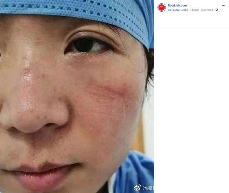 Korona izleri yüzlerinde 9
