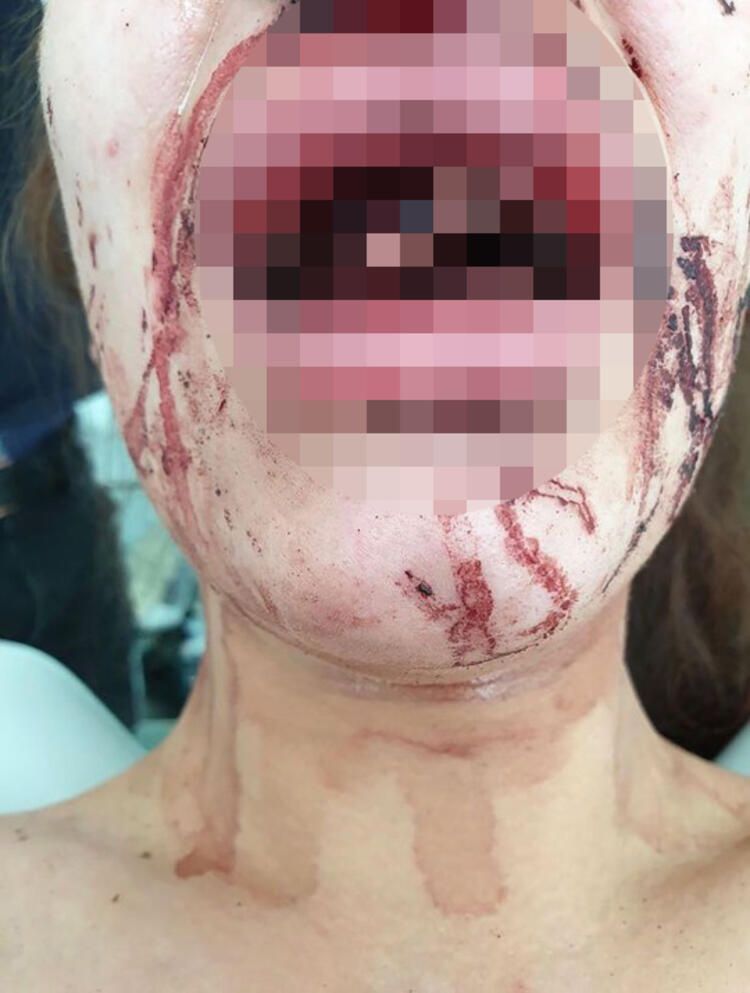 İki kadın iki dehşet! Tanınmaz hale geldiler... 6