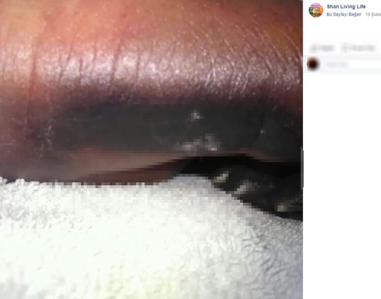 Bir ısırık 66 ameliyat! Hayatı karardı... 13