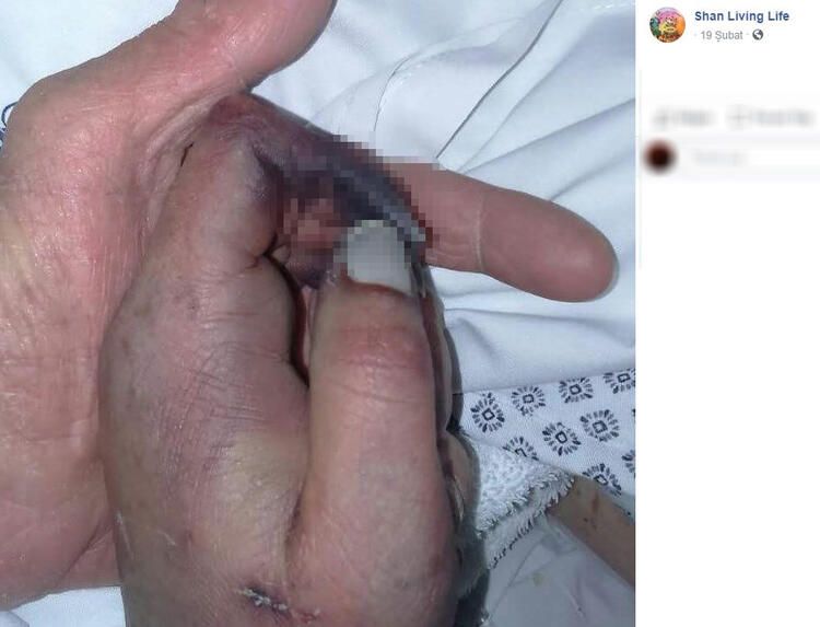 Bir ısırık 66 ameliyat! Hayatı karardı... 14