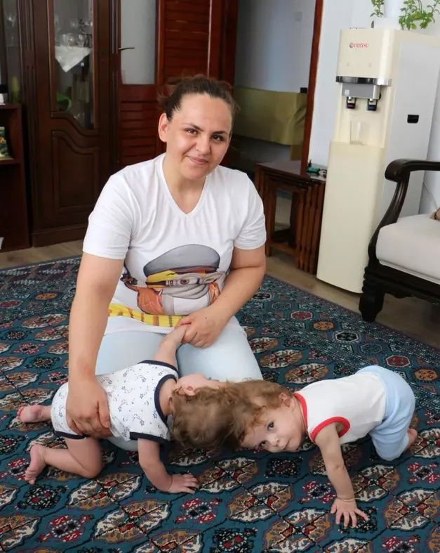 Siyam ikizlerinden ilk görüntü! 2