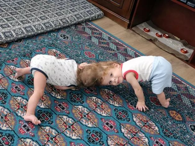 Siyam ikizlerinden ilk görüntü! 5