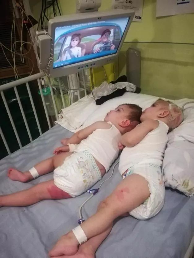 Siyam ikizlerinden ilk görüntü! 10