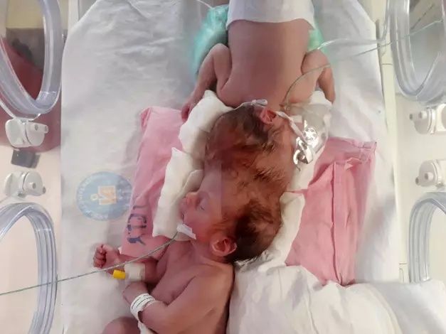Siyam ikizlerinden ilk görüntü! 7