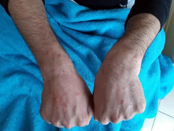 210 hastanın deri bulguları incelendi 2