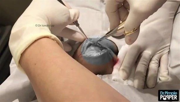 17 yıl boyunca kafasında solucanla yaşadı! 10