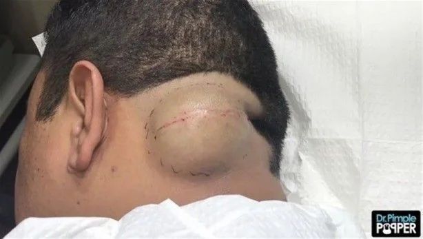 17 yıl boyunca kafasında solucanla yaşadı! 6