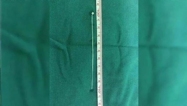 17 yıl boyunca kafasında solucanla yaşadı! 5