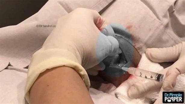 17 yıl boyunca kafasında solucanla yaşadı! 13