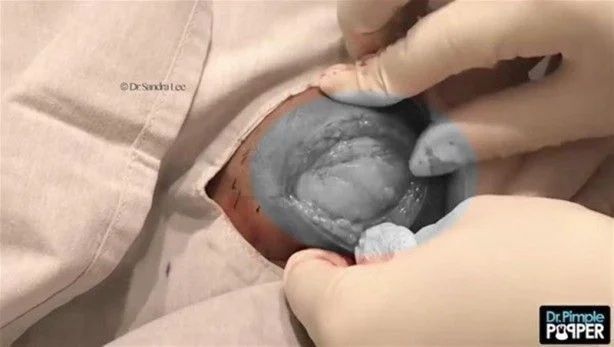 17 yıl boyunca kafasında solucanla yaşadı! 14