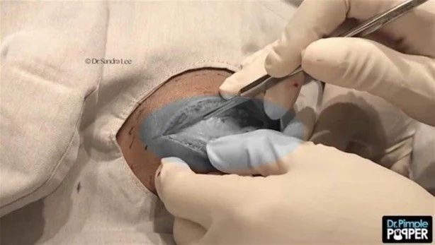 17 yıl boyunca kafasında solucanla yaşadı! 12