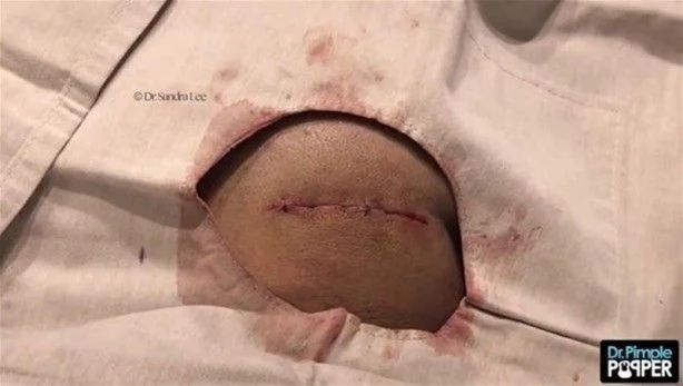 17 yıl boyunca kafasında solucanla yaşadı! 17