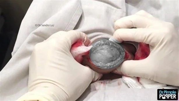 17 yıl boyunca kafasında solucanla yaşadı! 9