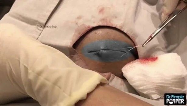 17 yıl boyunca kafasında solucanla yaşadı! 15