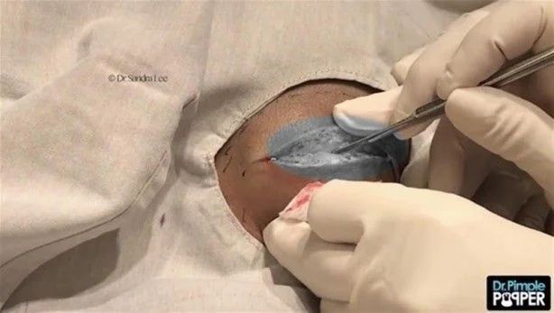 17 yıl boyunca kafasında solucanla yaşadı! 11