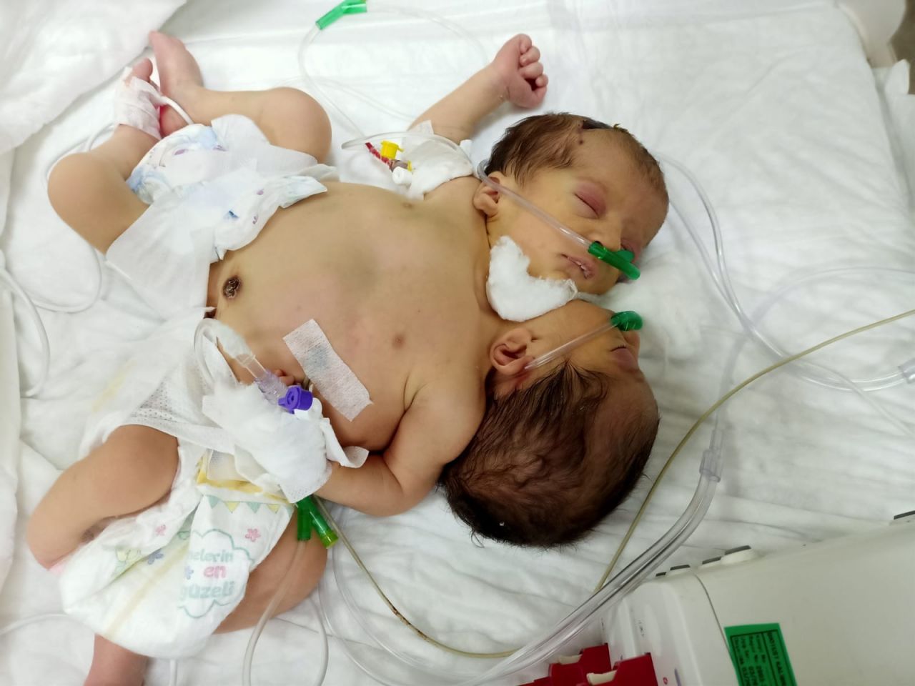 Afrinli siyam ikizlerine Türkiye umut oldu 1