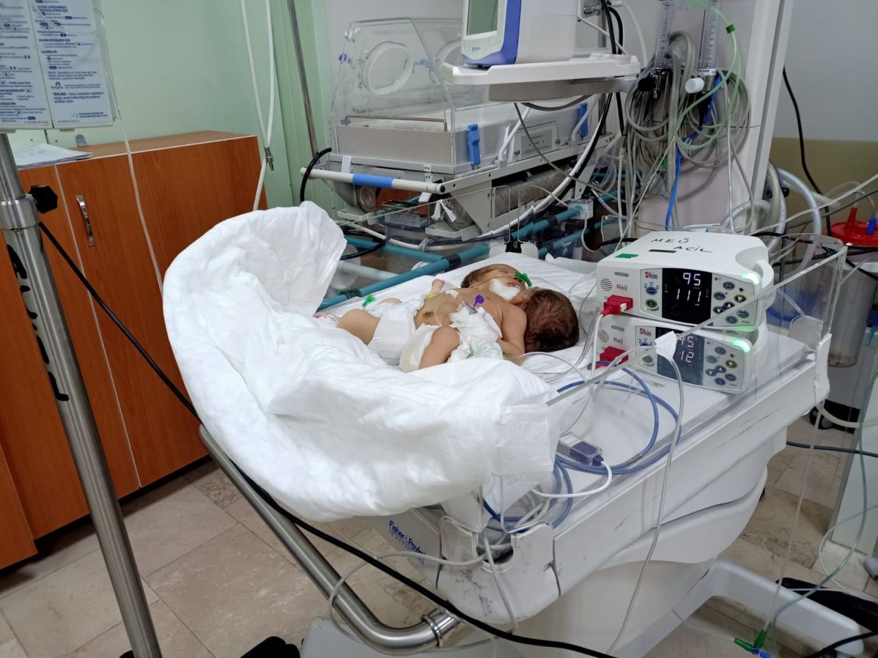 Afrinli siyam ikizlerine Türkiye umut oldu 3