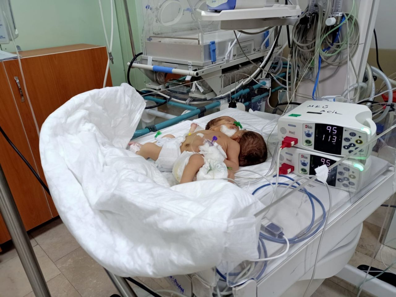 Afrinli siyam ikizlerine Türkiye umut oldu 5