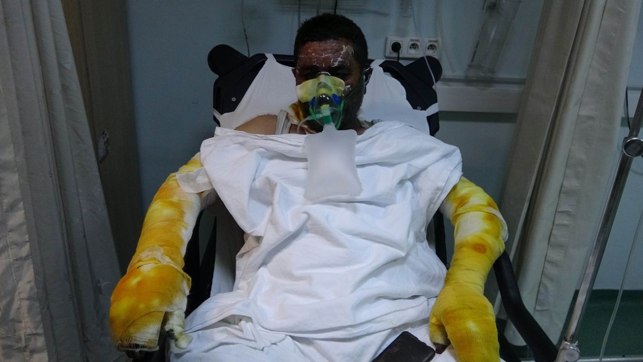 Yangında ailesini yanmaktan kurtardı... Kendisi yanarak hastanelik oldu! 3