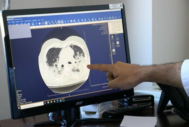 Doç. Dr. Taşçı: Kovid-19 akciğerdeki solunum keseciklerinde hasara yol açıyor 5