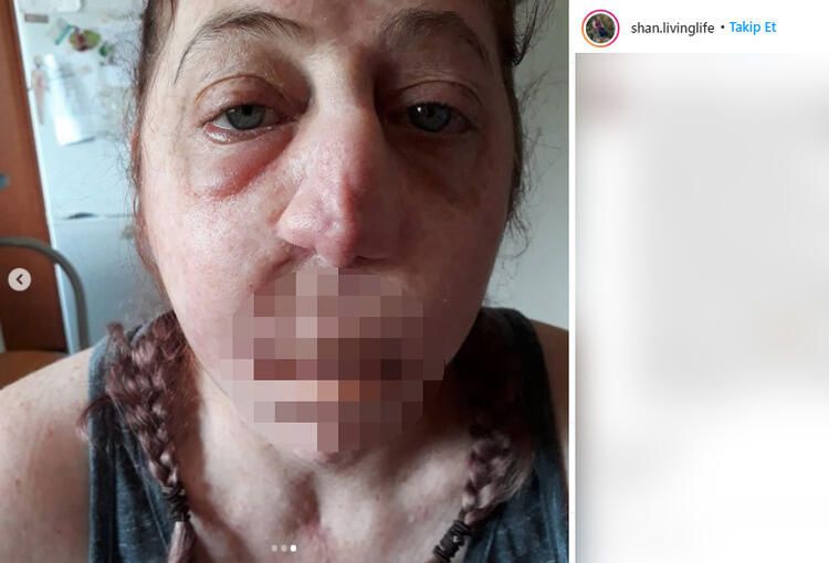 Fare ısırdı hayatı kabusa döndü! Burnu, dudakları, bacakları ve kolları kesildi... 6