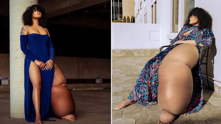 Bacaklarından biri 45 kilo! Fil hastalığı olan genç kadın kendiyle barışmayı öğrendi... 10