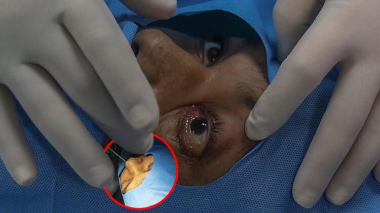 Kara mantar ameliyatından tüyler ürperten görüntüler: Gözler böyle oyuluyor... 1
