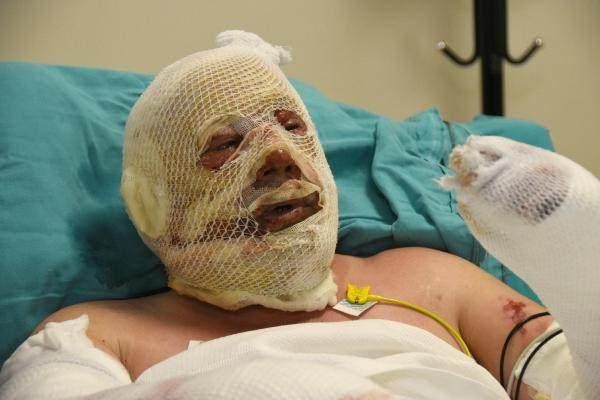 Alevlerin arasında kalan kahraman ormancı: Bir cesaret geldi koşmaya başladım! 3