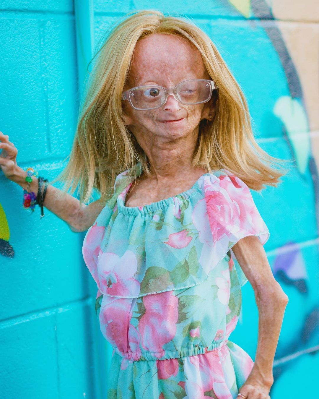 Erken yaşlanan ünlü Youtuber'dan acı haber! Adalia Rose Williams 15 yaşında hayatını kaybetti 1