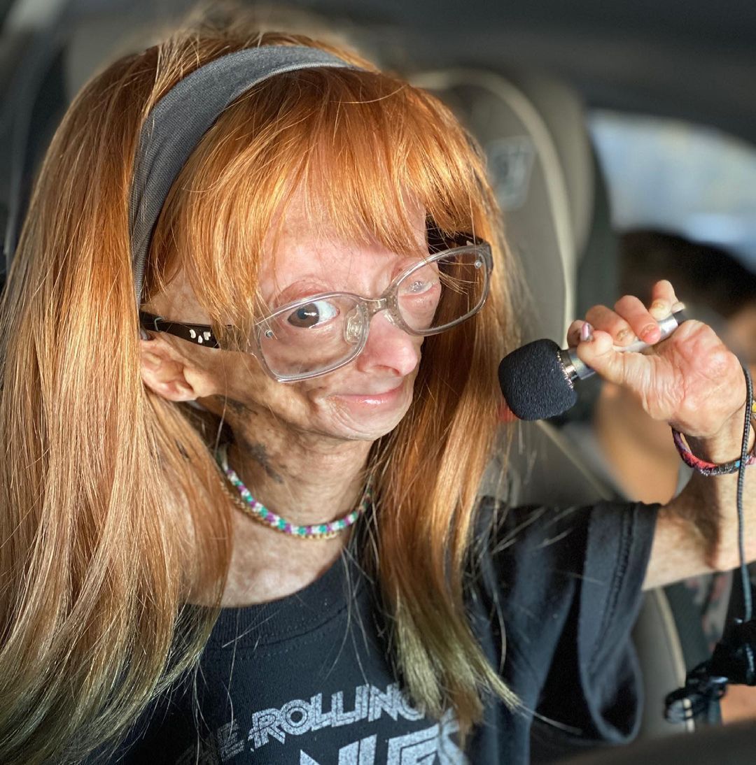 Erken yaşlanan ünlü Youtuber'dan acı haber! Adalia Rose Williams 15 yaşında hayatını kaybetti 17