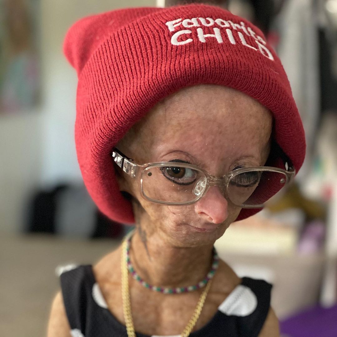 Erken yaşlanan ünlü Youtuber'dan acı haber! Adalia Rose Williams 15 yaşında hayatını kaybetti 18