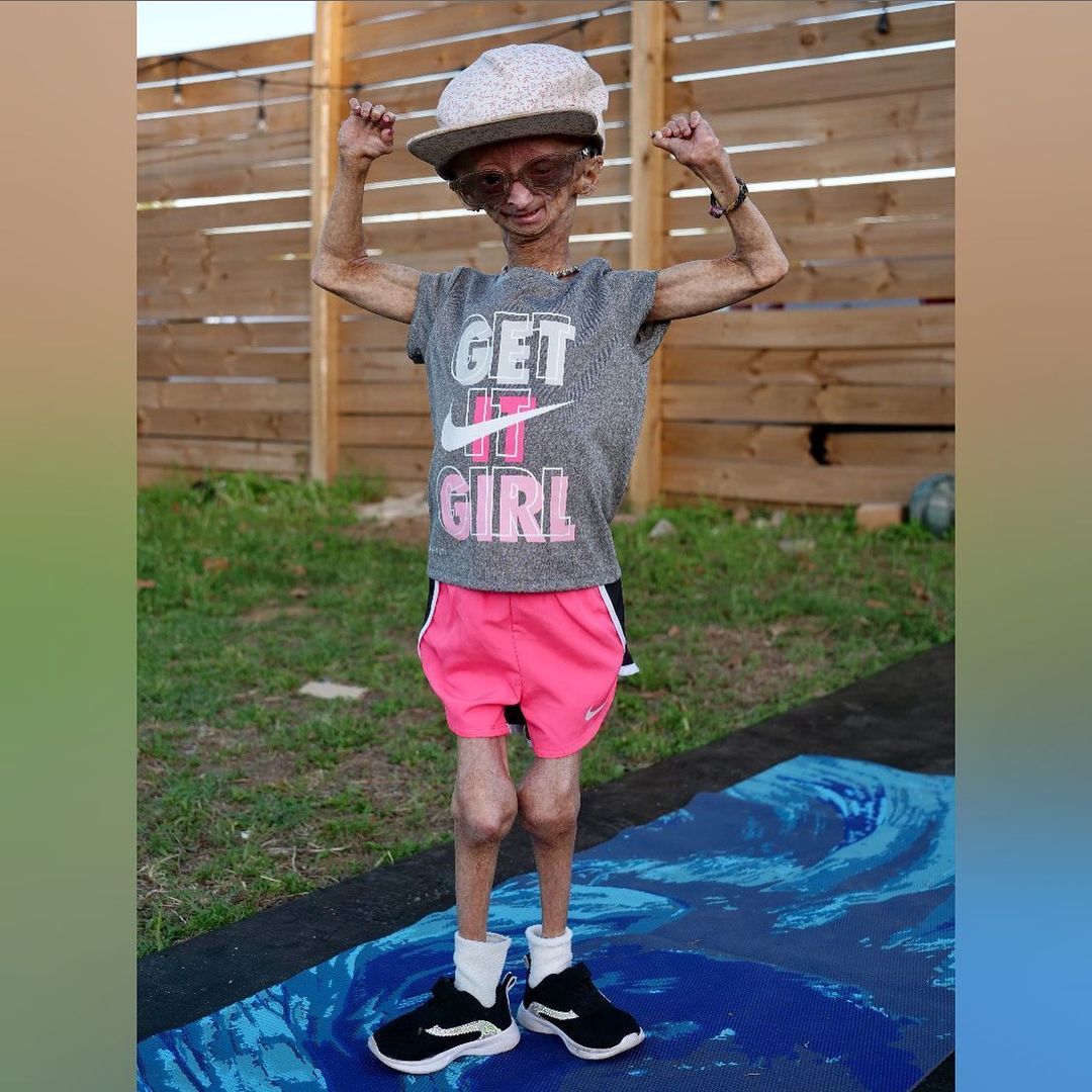 Erken yaşlanan ünlü Youtuber'dan acı haber! Adalia Rose Williams 15 yaşında hayatını kaybetti 19